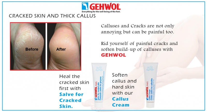Gehwol cracked hotsell heel cream